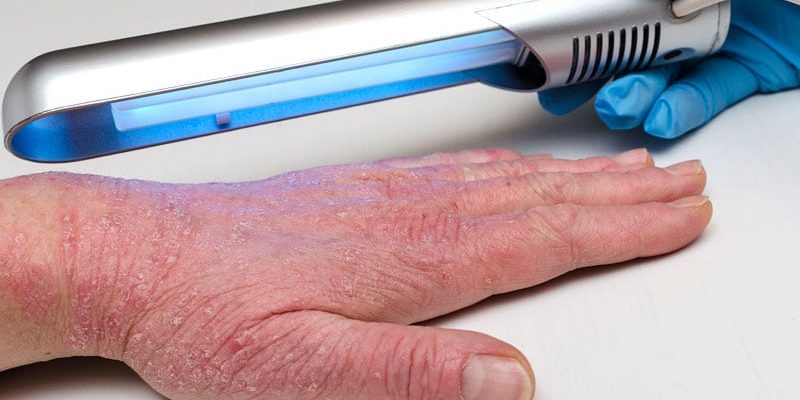 European Survey Finds Phototherapy Use Varies Widely for Eczema  All