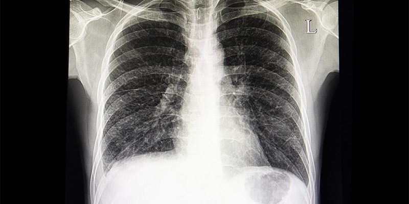 Lung Adverse Effects In Patients Taking Trastuzumab Deruxtecan - All My 